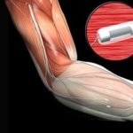 UNE NOUVELLE TECHNOLOGIE QUI PERMETTRAIT DE MIEUX SENTIR ET CONTRÔLER SA PROTHÈSE