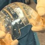 Une prothèse de crâne imprimée en 3D, encore une vie sauvée!