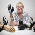 This bionic hand is fused to a woman’s bones, muscles, and nerves