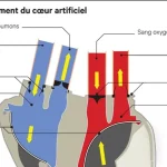 Carmat : Pourquoi ce coeur est révolutionnaire
