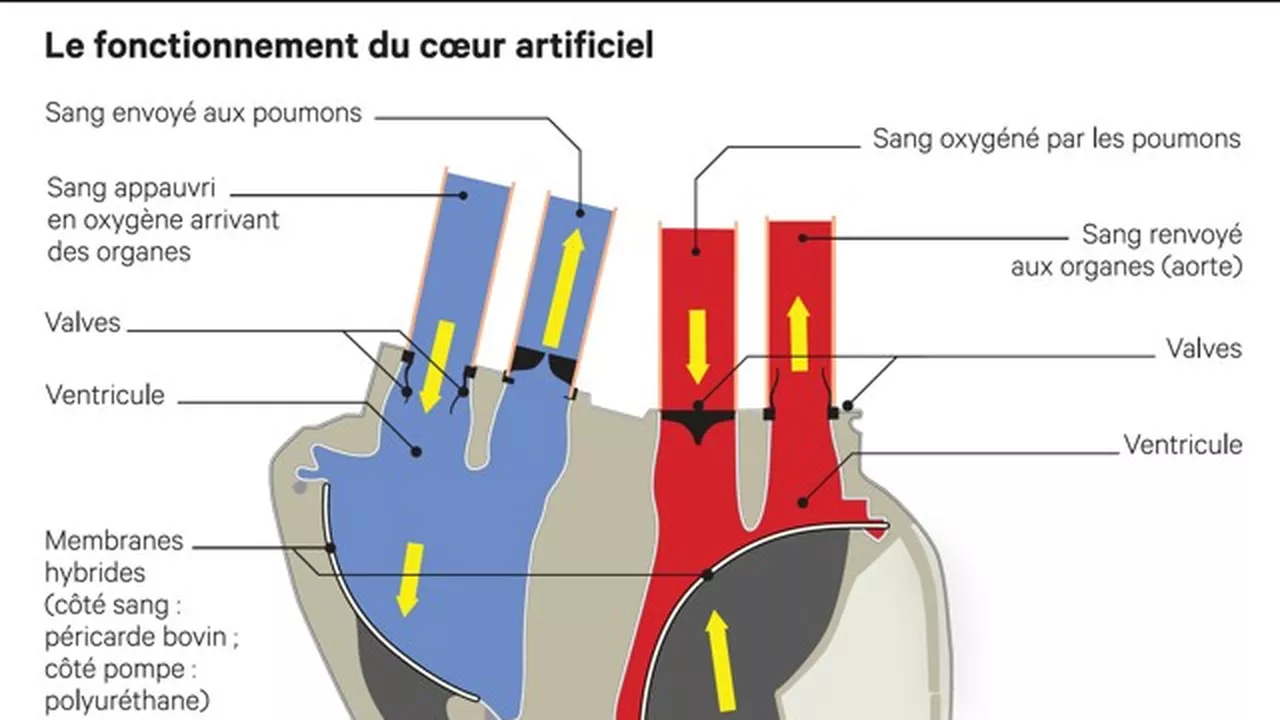 Carmat : Pourquoi ce coeur est révolutionnaire