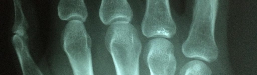 Un nanocomposite biodégradable et imprimable en 3D, pour la greffe osseuse