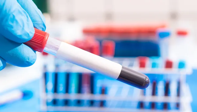 New blood test detects cancers 3 years before typical diagnosis, study hints