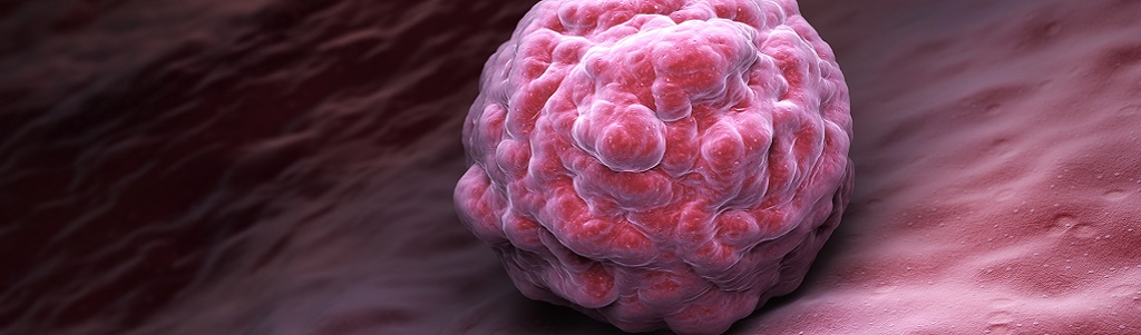 IA et recherche contre le cancer : six innovations inspirantes | Techniques de l&rsquo;Ingénieur