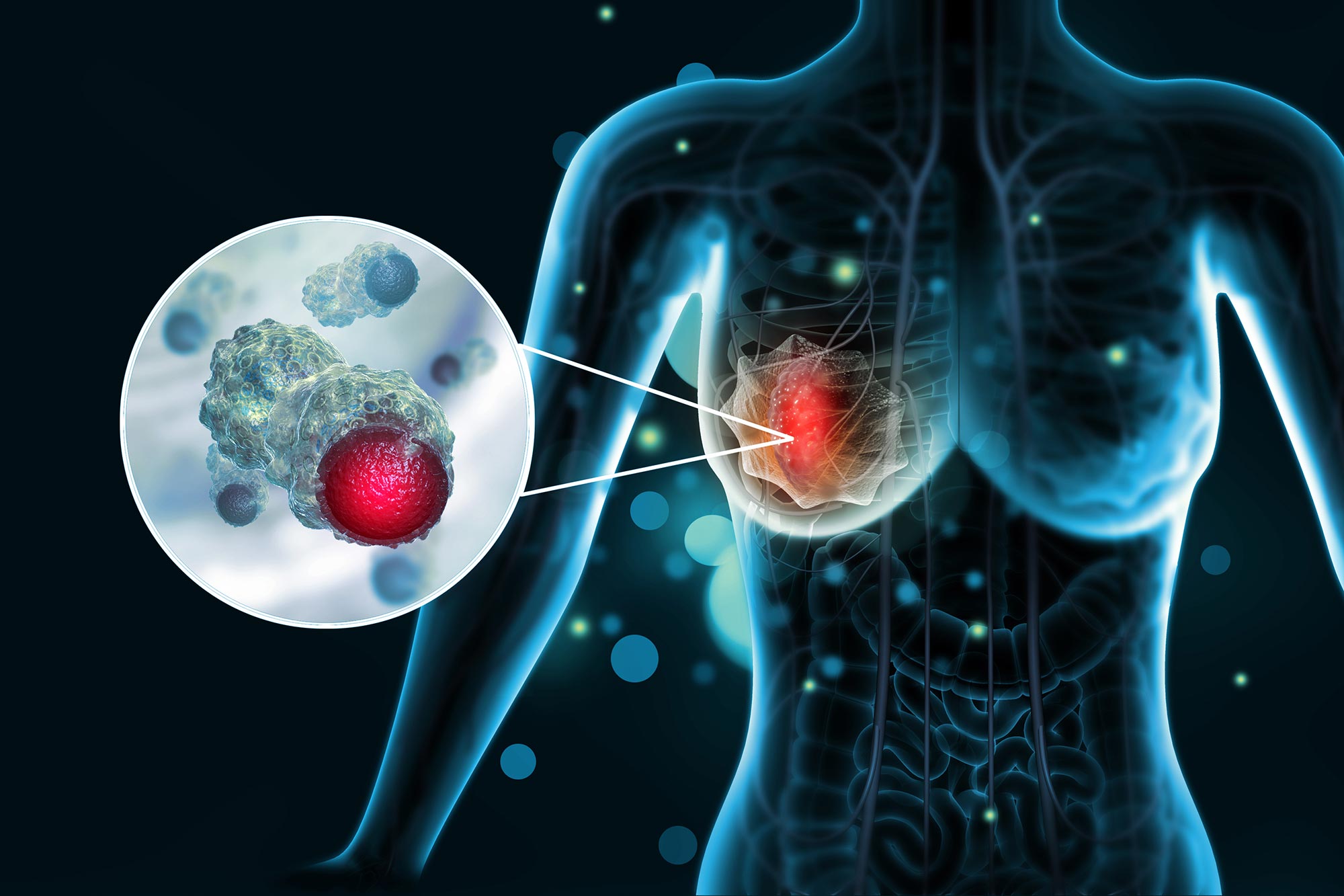 Popular GLP-1 Weight-Loss Drugs Linked to 30% Lower Breast Cancer Risk